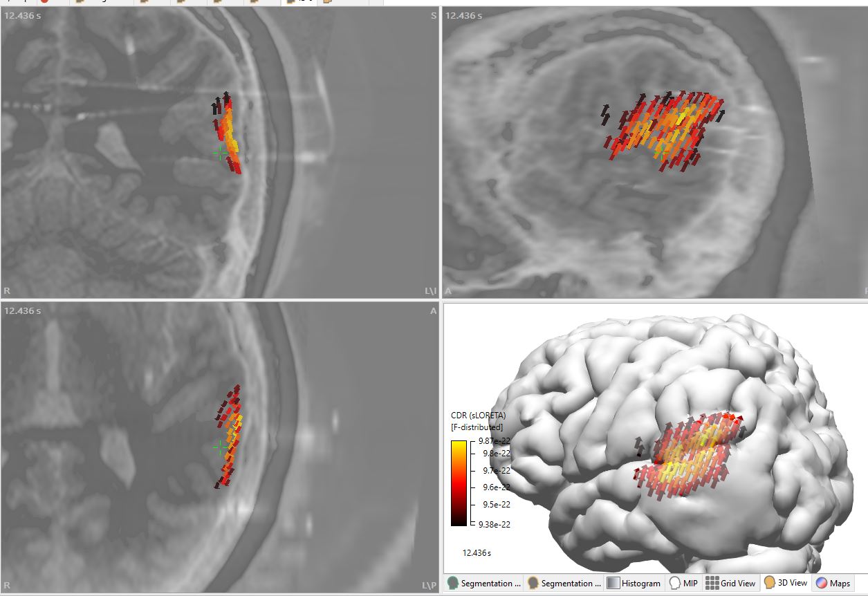 ESI preop and SEEG placement lesion
